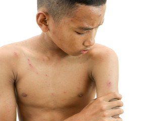 Naklejka premium Chickenpox bubble rash on a boy.