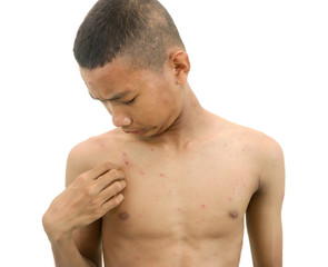 Chickenpox bubble rash on a boy.