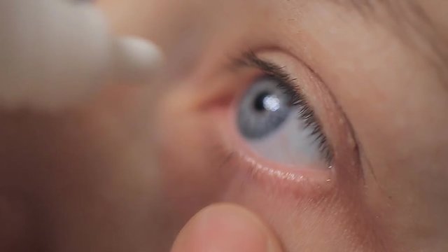 a young woman dripping medicinal drops in her eyes. close-up