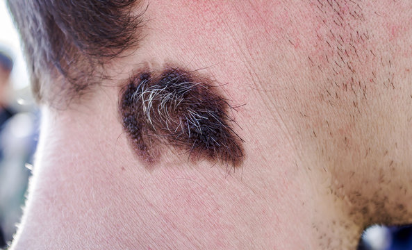 Birthmark with hair