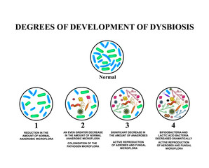 4 degrees of development of dysbiosis. Dysbacteriosis of the intestine. The large intestine. dysbiosis of colon. Bacteria, fungi, viruses. Infographics. Vector illustration on isolated background.