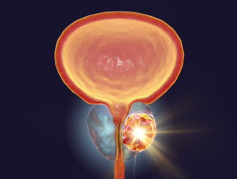 Conceptual image for prostate cancer treatment, 3D illustration showing destruction of a tumor inside prostate gland