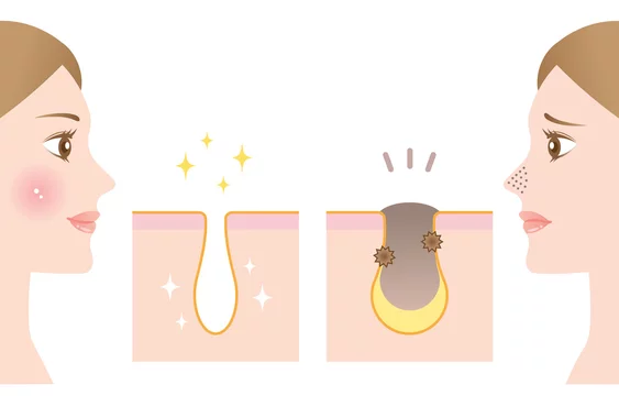 29 Best 角栓除去images Stock Photos Vectors Adobe Stock