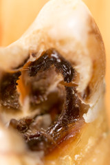 caries in the tooth. macro