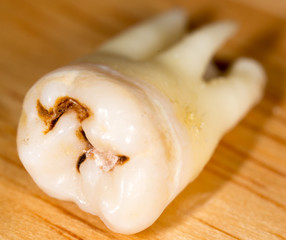 caries in the tooth. macro