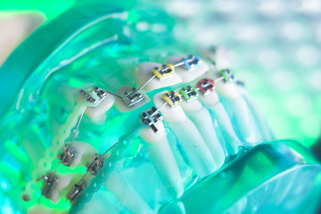 Dental teeth metal brackets