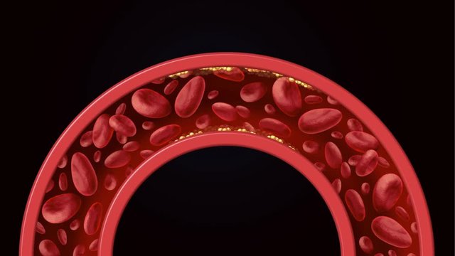 Coronary artery disease medical concept as a circular vein with gradual plaque formation as clogged arteries and atherosclerosis with with a human anatomy diagram of the risks of cholesterol buildup.