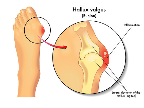 Symptoms Of Hallux Valgus