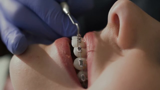 Orthodontist put on elastic on braces. Healthy teeth. Good smile of the patient