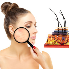 Post-Acne Marks /Treating Acne Scars