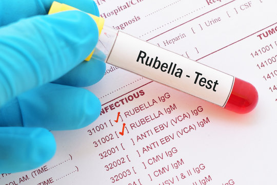 Blood sample with requisition form for rubella virus test
