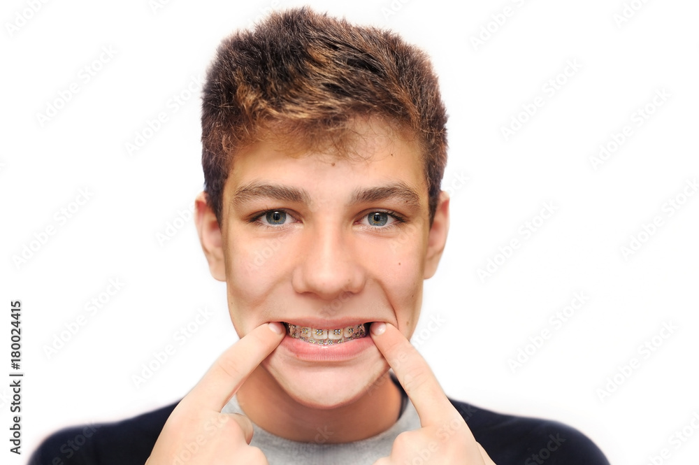 Wall mural a good guy on a white background smiles and shows a brace on his teeth with two fingers