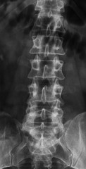 X-Ray of the Spine