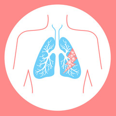 icon of lung disease hit