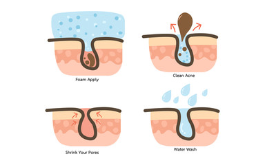 Acne Clean Process
