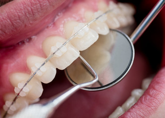 Dentist checking up teeth with ceramic brackets using dental tools - probe and mirror at the dental...