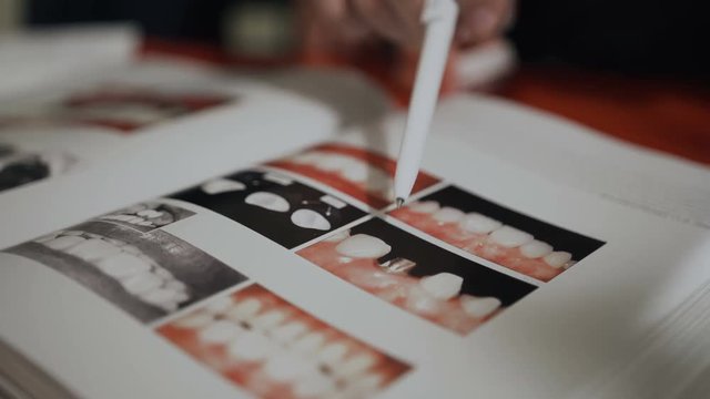 Aesthetic ceramic lining is used to restore the shape and function of the frontal group of teeth