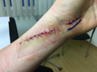 Frische Narbe nach einer Operation