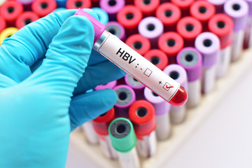 Fototapeta premium Blood sample positive with hepatitis B virus (HBV)