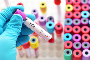 Fototapeta premium Blood sample positive with hepatitis C virus (HCV)