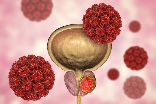 Conceptual image for viral ethiology of prostate cancer. 3D illustration showing Human Papilloma Viruses HPV infecting prostate gland which develops cancerous tumor