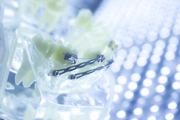 Dental teeth brackets aligners