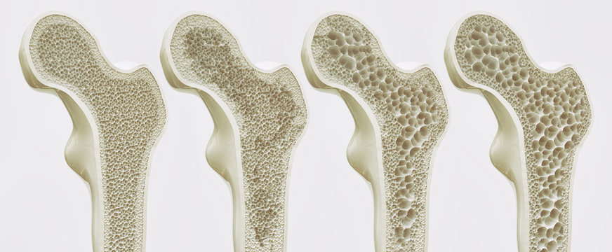 4 Stadien der Osteoporose