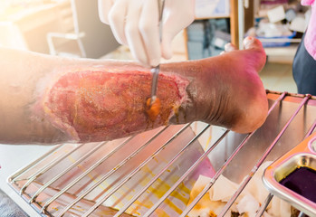 closeup  infection wound in the leg of patients . 