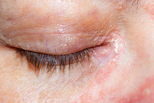 Psoriasis am auge