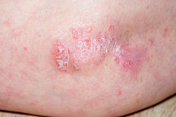 Psoriasis am ellenbogen