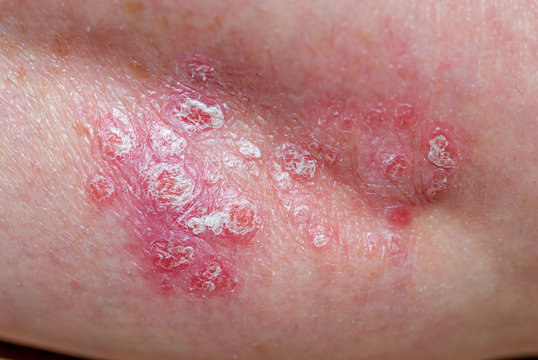 Psoriasis am ellenbogen