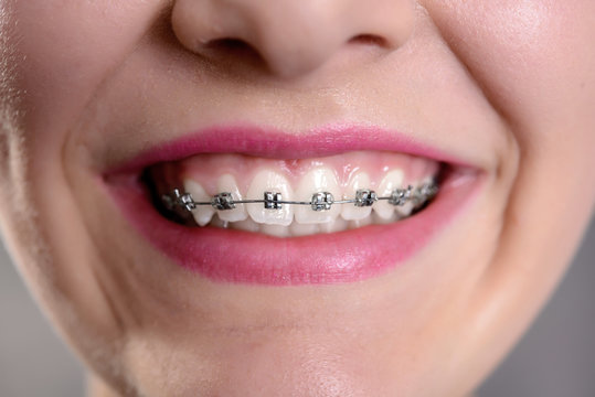 Smiling Girl Showing Her Fixed Braces