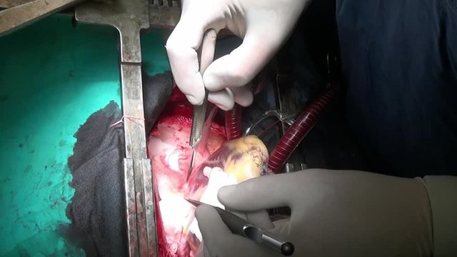 Heart surgery on live organ of patient in hospital. Struggle for life. Operation in clinic. Unique macro video close up.