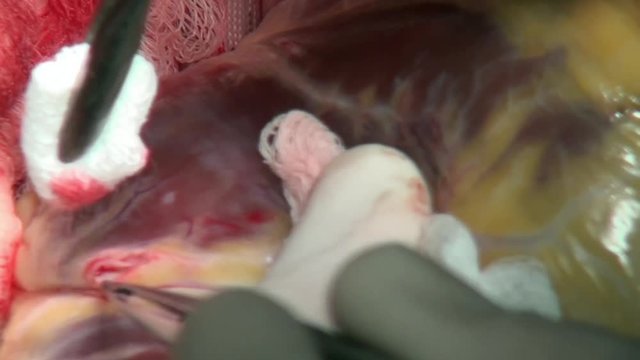 Heart surgery unique macro video close up in clinic. Struggle for life. Operation on live organ of patient in hospital.