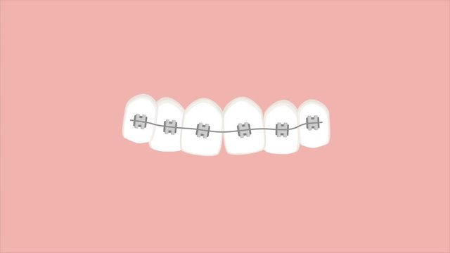 Video animation of braces straightening teeth