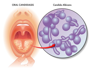 vector medical illustration of the symptoms of oral candidiasis