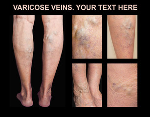 Painful varicose veins,,spider veins, varices on a severely affected leg. Ageing, old age disease, aesthetic problem concept.