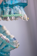 Classic dental metal orthodontics with colored hooks
