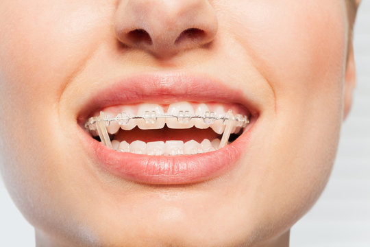 Female mouth with orthodontic elastics on braces