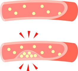 コレステロールが溜まって狭まった血管