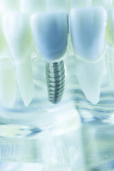 Dental titanium tooth implant
