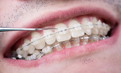 Obraz premium Dentist checking up teeth with ceramic brackets using probe at the dental office. Macro shot of teeth with braces. Orthodontic Treatment. Dentistry