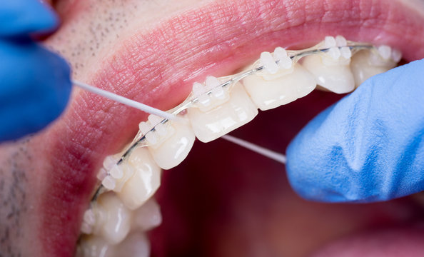 Dentist Flossing Teeth With Ceramic Brackets, Using Floss At The Dental Office. Macro Shot Of Teeth With Braces. Orthodontic Treatment. Oral Hygiene And Health Care. Dentistry