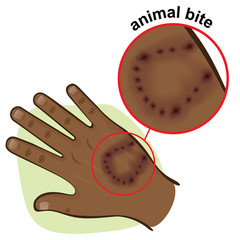 Illustration is part of the human body, hand with an animal bite, African descent. Ideal for first aid, medical and institutional materials