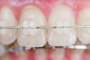 Super macro shot of teeth with braces. Dentistry