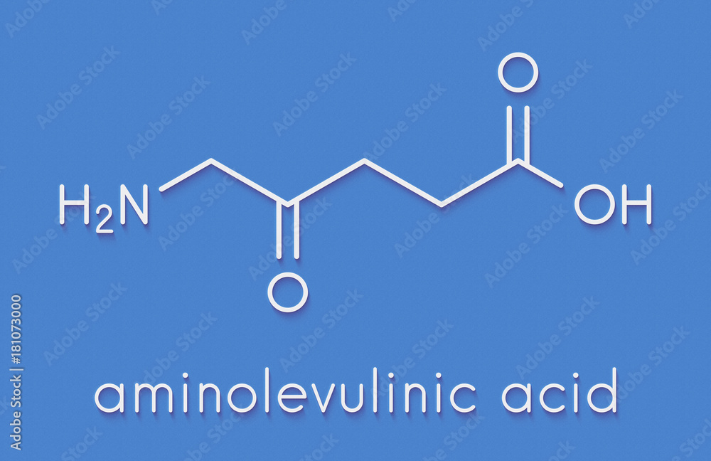 Poster d-aminolevulinic acid (ALA) drug molecule. Used in diagnosis and treatment (photodynamic therapy) of cancer. Skeletal formula.