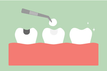tooth amalgam filling with dental tools