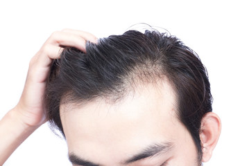 Fototapeta premium Young man serious hair loss problem for health care medical and shampoo product concept