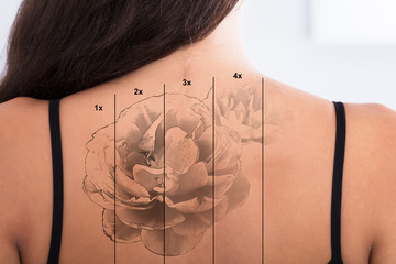 Laser Tattoo Removal On Woman's Back