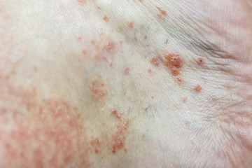 Fototapeta premium Eczema - Foot disease on the foot of the foot.